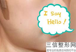 唇峰不明显可以整形吗，做唇峰多少钱