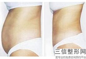 大腿抽脂维持多久，大腿抽脂要多久恢复