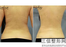 大腿抽脂维持多久，大腿抽脂要多久恢复