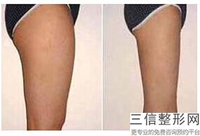 大腿吸脂手术术后恢复期要注意什么，大腿吸脂术后恢复过程
