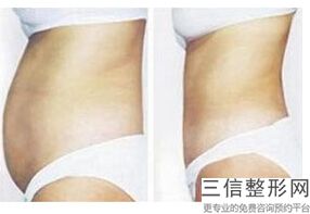 大腿吸脂手术术后恢复期要注意什么，大腿吸脂术后恢复过程