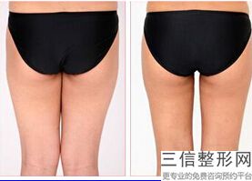 大腿吸脂有效果吗，瘦大腿除了吸脂还有什么方法