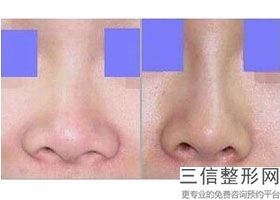 单做假体隆鼻，宁波哪里做假体隆胸好