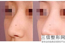 单做假体隆鼻，宁波哪里做假体隆胸好