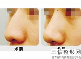 蛋白隆鼻怎么样啊，胶原蛋白隆鼻有用吗