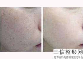 肚子吸脂后皮肤会松弛吗,腹部吸脂后肚皮很难看怎么办