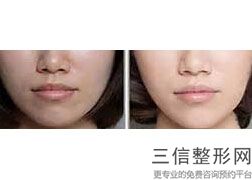 肚子吸脂后皮肤会松弛吗,腹部吸脂后肚皮很难看怎么办