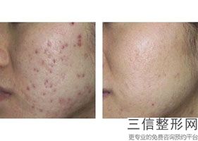 肚子吸脂后皮肤会松弛吗,腹部吸脂后肚皮很难看怎么办