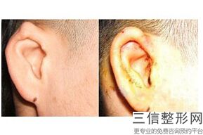耳膜修复哪里做的好,手术修复耳膜哪里比较专业