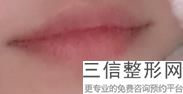 丰唇手术是怎么做的，做丰唇好吗