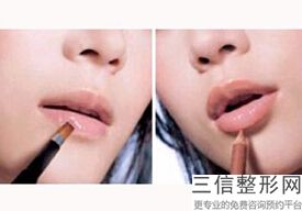 丰唇手术是怎么做的，做丰唇好吗