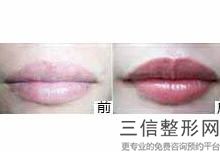 丰唇良好的办法，丰唇手术原理