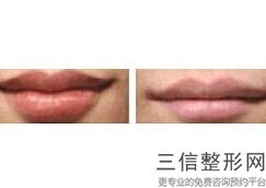 丰唇良好的办法，丰唇手术原理
