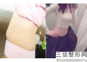 丰胸手术效果怎样,丰胸效果整形手术