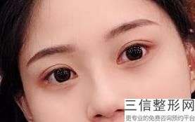 佛山市做双眼皮大概什么价格，佛山做双眼皮大概什么价格
