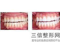 氟斑牙能美白吗，什么是氟斑牙-氟斑牙如何美白