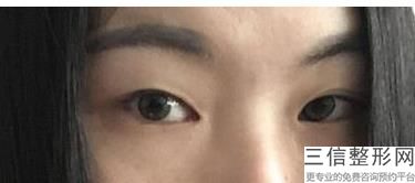 割双眼皮好害怕，割双眼皮疼不疼