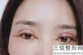 割双眼皮微创和全切的区别,割双眼皮属于微创手术吗