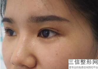 割双眼皮微创和全切的区别,割双眼皮属于微创手术吗