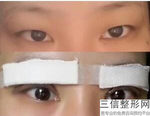 各种双眼皮适合的脸型，双眼皮类型适合什么脸型