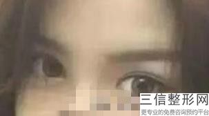 各种双眼皮适合的脸型，双眼皮类型适合什么脸型