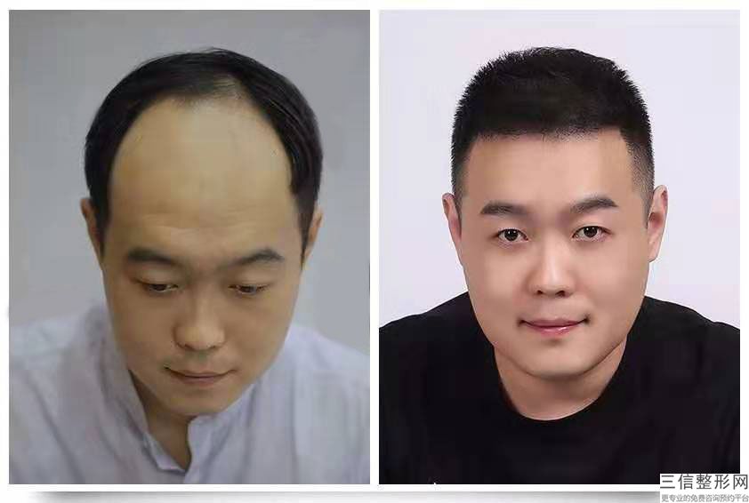 广州市种植头发医院哪家比较好，广州做植发良好的医院