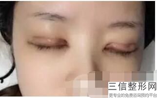 杭州双眼皮修复医生推荐，杭州哪家医院修复双眼皮比较好