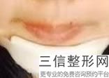 厚唇改薄唇珠肿了好几个月，厚唇改薄多久能消肿