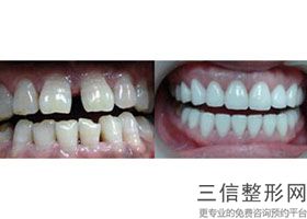 后槽牙矫正，正畸牙齿压回牙槽骨