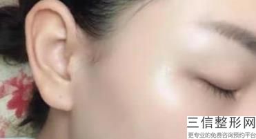 激光超声刀去除眼袋哪个效果好，请问有做过超声波去眼袋的经验吗