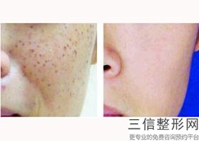 激光美白和光子嫩肤哪个美白效果好,皮肤可以激光美白吗
