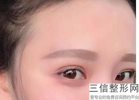 激光去眼袋有效果吗 能彻底做好吗，激光去眼袋有没有后遗症