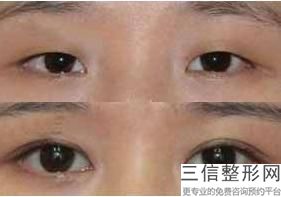激光去眼角细纹可以保持多久，去眼下细纹做什么手术好