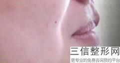 激光脱唇毛大约多少钱，唇毛激光脱毛做一次多少钱