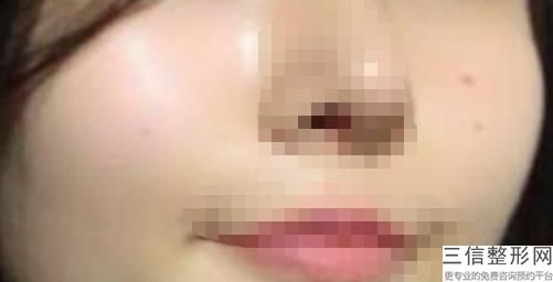 激光脱唇毛大约多少钱，唇毛激光脱毛做一次多少钱