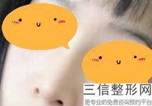 假体隆鼻平时要怎么护理，做完鼻子假体后要怎么护理