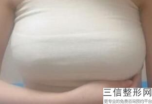 假体隆胸年龄要求，多大年龄比较适合做假体隆胸