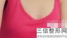 假体隆胸有哪些危害，假体隆胸对身体危害大吗