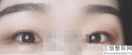 开眼角后眼角会不会回缩，开外眼角会回缩吗-