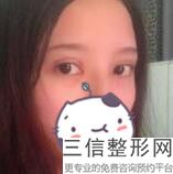 开眼角手术有什么用，多大年龄适合做开眼角手术