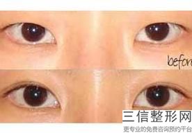 开眼角需要恢复多长时间,开眼角恢复期要多久