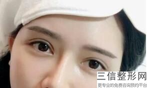开眼角需要恢复多长时间,开眼角恢复期要多久