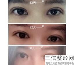 开眼角要恢复多久，开眼角需要恢复多久