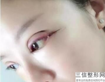 开眼角要恢复多久，开眼角需要恢复多久