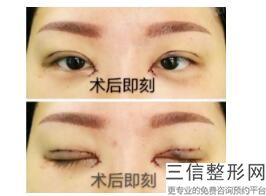 开眼角怎么能不留疤,眼睛开眼角会留疤吗
