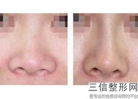 肋软骨隆鼻可以维持一辈子吗，肋软骨隆鼻手术危险吗