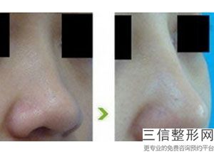 肋软骨做鼻梁，软肋骨垫鼻子有风险吗