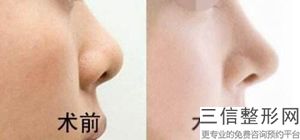 隆鼻失败了怎么处理，隆鼻要修复吗