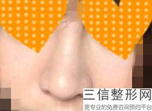 隆鼻要注意哪些，有什么办法可以隆鼻
