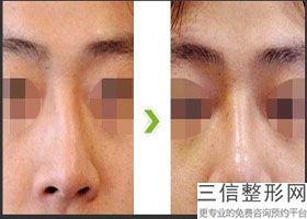 隆鼻要注意哪些，有什么办法可以隆鼻